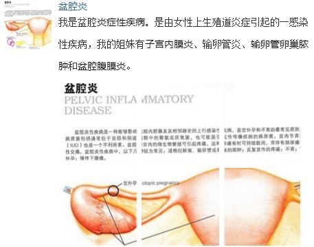 为什么会被盆腔炎缠身(图1)